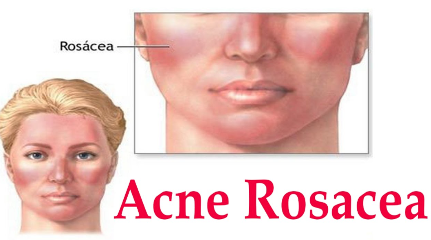 Розацея это такое у женщин схема. Розацеа - болезнь Морбигана. Розацея лицо начальная стадия.